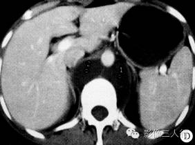 【病例】腹膜后区囊性淋巴管瘤伴出血1例CT影像表现 【病例】腹膜后区囊性淋巴管瘤伴出血1例CT影像表现
