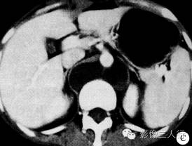 【病例】腹膜后区囊性淋巴管瘤伴出血1例CT影像表现 【病例】腹膜后区囊性淋巴管瘤伴出血1例CT影像表现