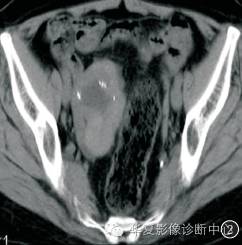 【病例】右侧卵巢甲状腺肿1例CT影像表现 【病例】右侧卵巢甲状腺肿1例CT影像表现