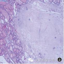 【病例】右侧卵巢甲状腺肿1例CT影像表现 【病例】右侧卵巢甲状腺肿1例CT影像表现