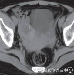 【病例】右侧卵巢甲状腺肿1例CT影像表现