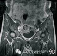 【病例】黄色肉芽肿性膀胱炎1例CT及MR影像表现