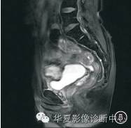 【病例】黄色肉芽肿性膀胱炎1例CT及MR影像表现