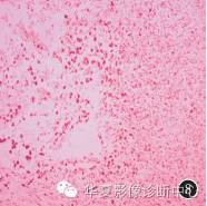 【病例】黄色肉芽肿性膀胱炎1例CT及MR影像表现