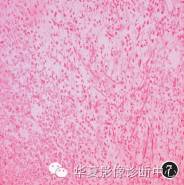 【病例】黄色肉芽肿性膀胱炎1例CT及MR影像表现