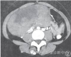 【病例】卵巢无性细胞瘤1例CT影像表现 【病例】卵巢无性细胞瘤1例CT影像表现