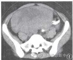 【病例】卵巢无性细胞瘤1例CT影像表现