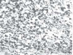【病例】卵巢无性细胞瘤1例CT影像表现 【病例】卵巢无性细胞瘤1例CT影像表现