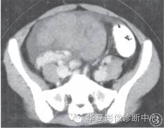 【病例】卵巢无性细胞瘤1例CT影像表现 【病例】卵巢无性细胞瘤1例CT影像表现