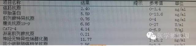 【病例】中枢神经系统淋巴瘤1例MR影像表现