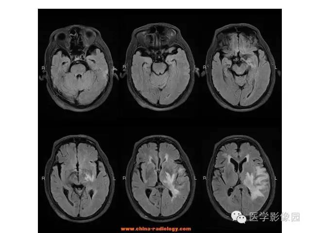 【病例】中枢神经系统淋巴瘤1例MR影像表现