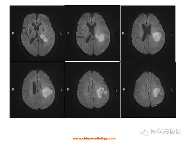 【病例】中枢神经系统淋巴瘤1例MR影像表现