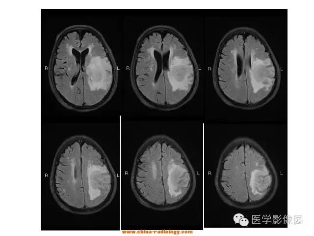 【病例】中枢神经系统淋巴瘤1例MR影像表现