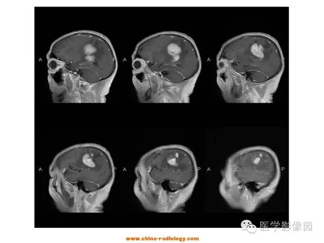 【病例】中枢神经系统淋巴瘤1例MR影像表现