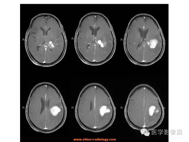 【病例】中枢神经系统淋巴瘤1例MR影像表现