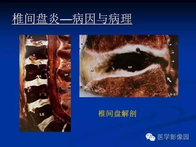【PPT】椎间盘炎MRI诊断