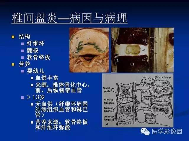 【PPT】椎间盘炎MRI诊断