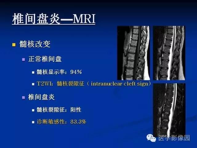 【PPT】椎间盘炎MRI诊断