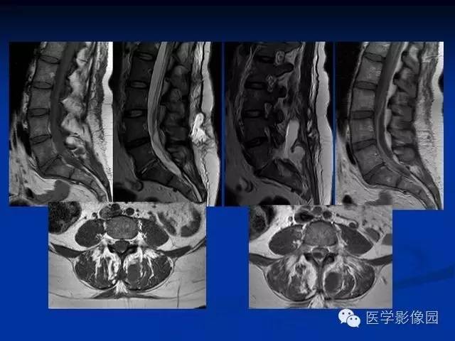【PPT】椎间盘炎MRI诊断