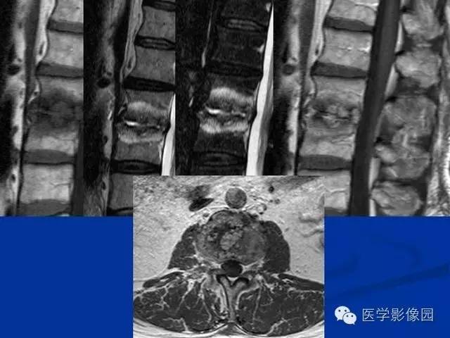 【PPT】椎间盘炎MRI诊断