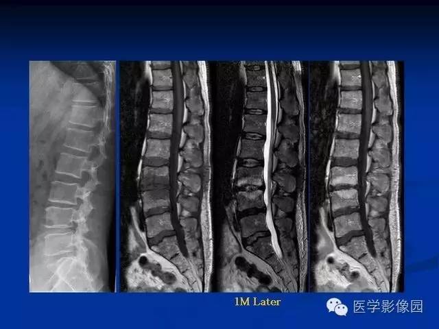 【PPT】椎间盘炎MRI诊断