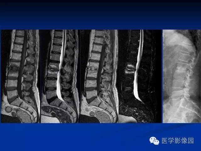 【PPT】椎间盘炎MRI诊断