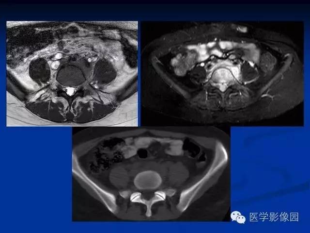 【PPT】椎间盘炎MRI诊断