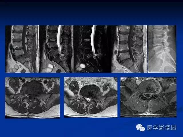 【PPT】椎间盘炎MRI诊断