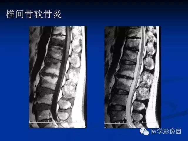 【PPT】椎间盘炎MRI诊断