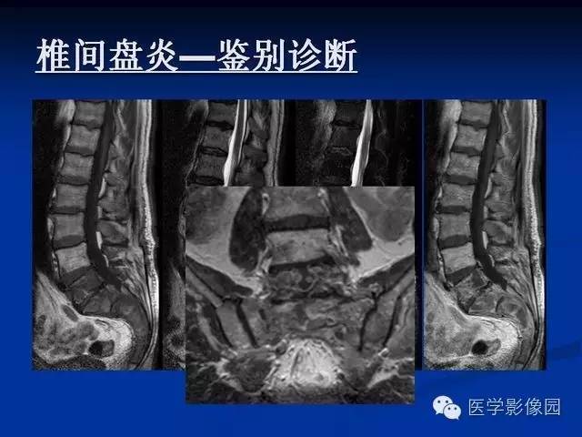 【PPT】椎间盘炎MRI诊断