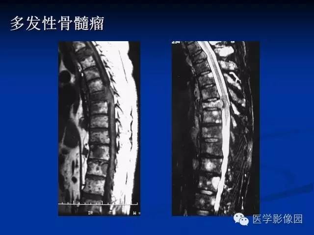 【PPT】椎间盘炎MRI诊断