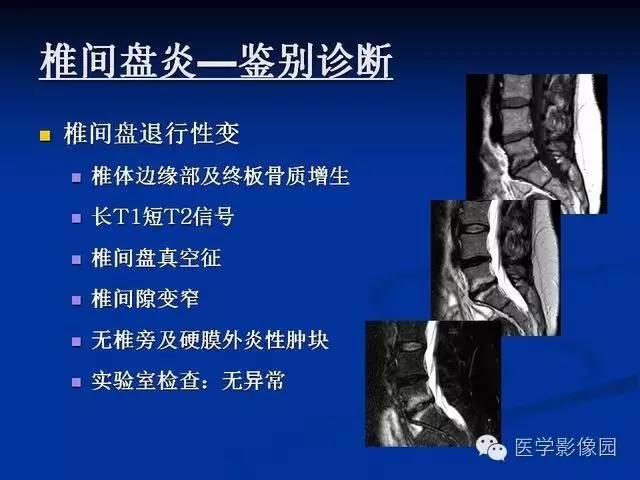 【PPT】椎间盘炎MRI诊断