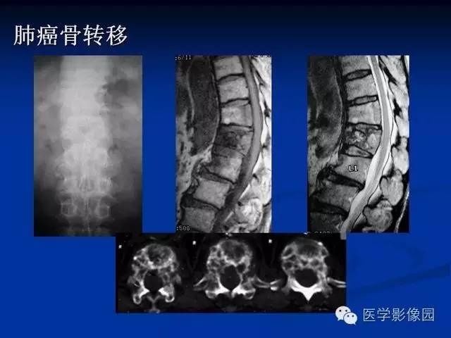【PPT】椎间盘炎MRI诊断