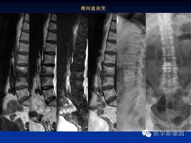 【PPT】椎间盘炎MRI诊断