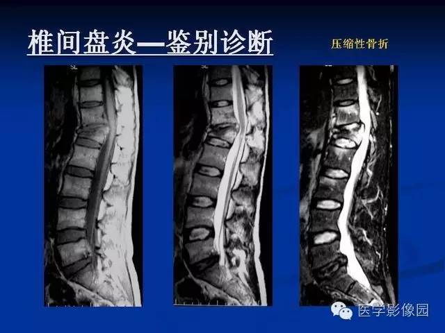 【PPT】椎间盘炎MRI诊断