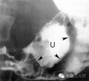 "半月征"，这个征象提示啥？
