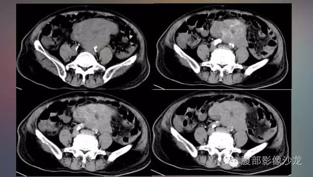 【病例】腹腔未分化多形性肉瘤1例CT影像表现 【病例】腹腔未分化多形性肉瘤1例CT影像表现