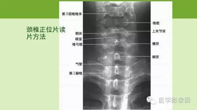 【PPT】颈椎影像阅片方法