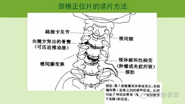 【PPT】颈椎影像阅片方法