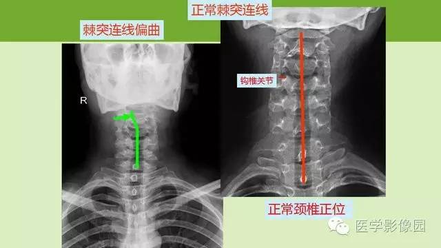 【PPT】颈椎影像阅片方法
