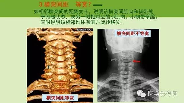 【PPT】颈椎影像阅片方法