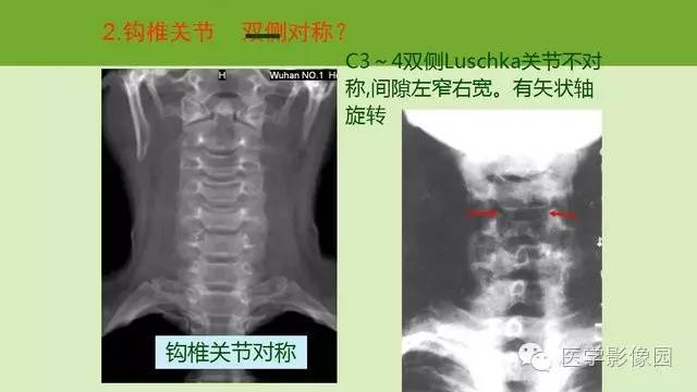 【PPT】颈椎影像阅片方法