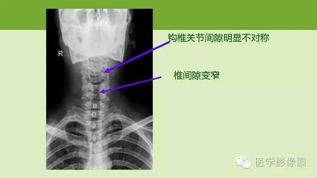 【PPT】颈椎影像阅片方法