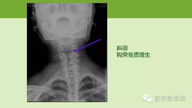 【PPT】颈椎影像阅片方法