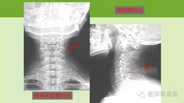 【PPT】颈椎影像阅片方法