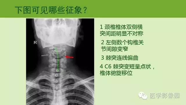 【PPT】颈椎影像阅片方法