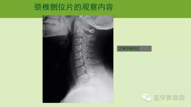 【PPT】颈椎影像阅片方法