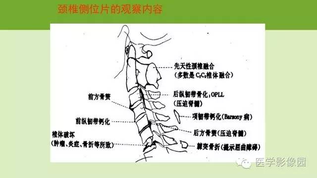 【PPT】颈椎影像阅片方法