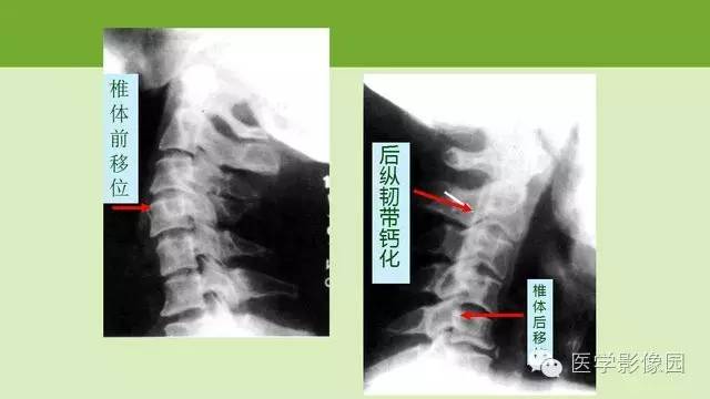 【PPT】颈椎影像阅片方法