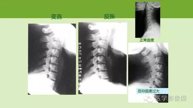 【PPT】颈椎影像阅片方法